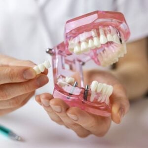 Dental Implant Education for Dentists