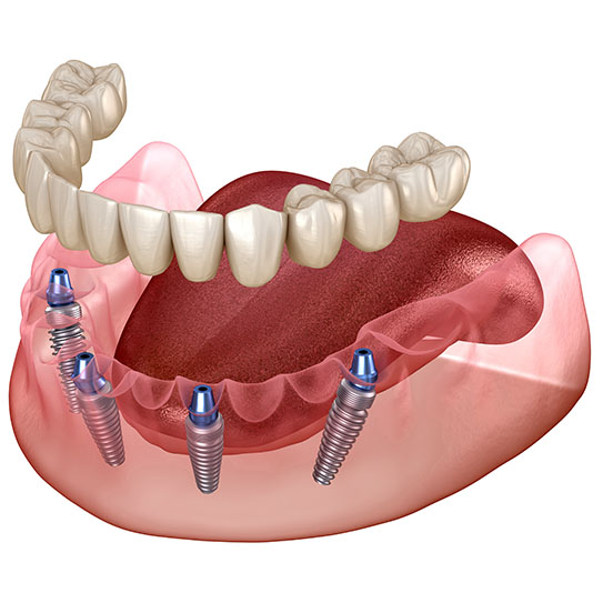 all-on-four dental implants