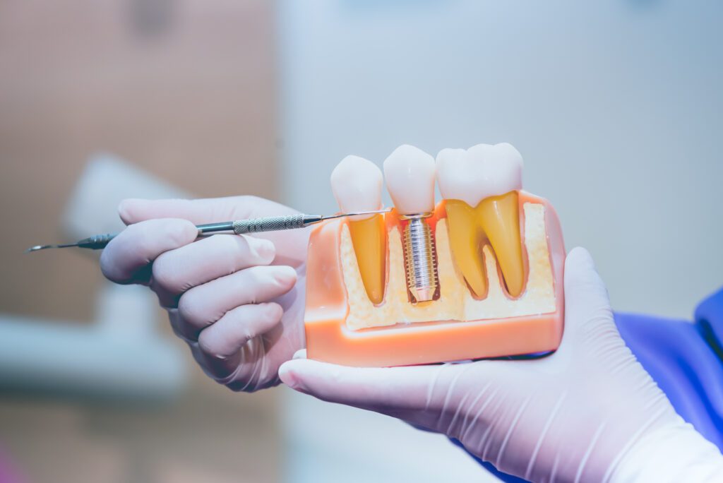 dental implant education