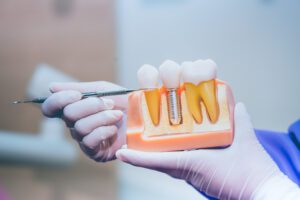 dental implant education